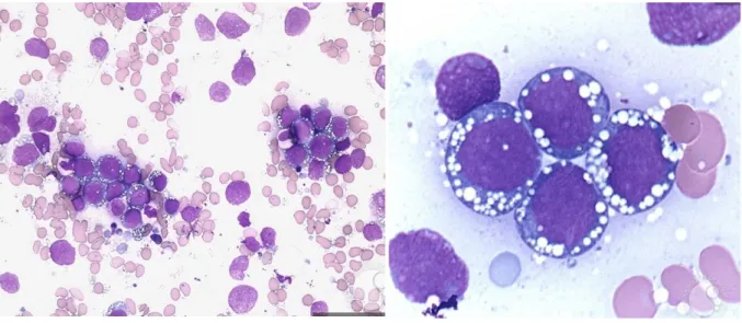 Figura 8 - Células neoplásicas em linfoma de Burkitt. Células com dimensão média, de citoplasma basófilo, vacúolos lipídicos