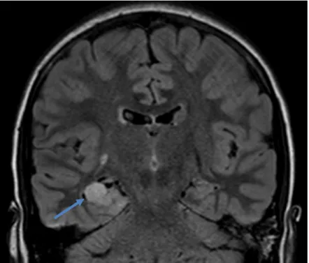 Figura  7  -  Imagem  FLAIR,  pré-operatório,  em  corte  coronal.  Evidencia  lesão  cortical  temporal  basal  direita com hipersinal, que corresponde ao tumor