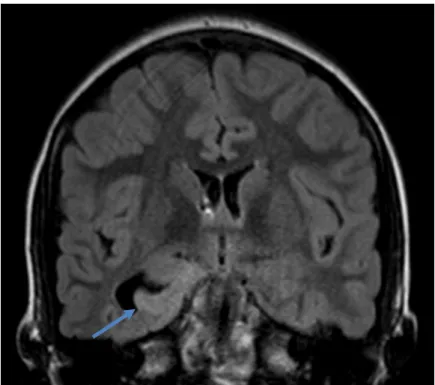 Figura  9  -  Imagem  FLAIR,  pré-operatório,  em  corte  coronal.  Evidencia  lesão  cortical  temporal  basal  direita com hipersinal, que corresponde ao tumor