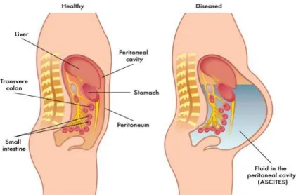 Figura 1.4- Esquema da cavidade peritoneal sem e com ascite [8] 