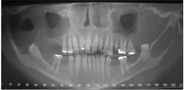 Figura 3. Reformatação panorâmica da tomografia computadorizada evidenciando áreas  hipodensas uniloculares, de margens e limites bem definidos, associadas aos elementos  dentários 38 e 48