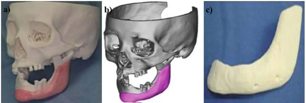 Figura 7 - Simulação através de um modelo tridimensional de um defeito ósseo na mandíbula, a)  representação artificial em 3D do osso no modelo, b) simulação do osso artificial com base na TAC, c) 