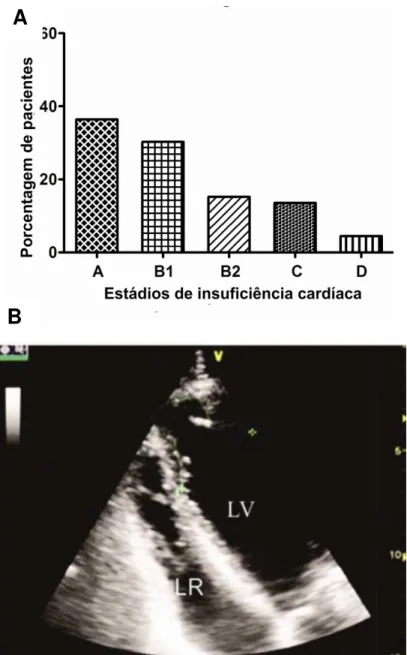 Figura 4 -  Apresentação dos pacientes com doença de Chagas crônica. Percentual de pacientes  com  diferentes  estádios  da  insuficiência  cardíaca  (A)  e  aneurisma  apical  do  ventrículo  esquerdo  ao ecocardiograma, em corte apical modificado (B).