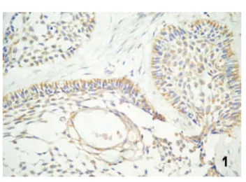 Figure 2. Focal labeling for integrin α3β1 in the follicular type of ameloblastoma (streptavidin–biotin, magnification ×400).
