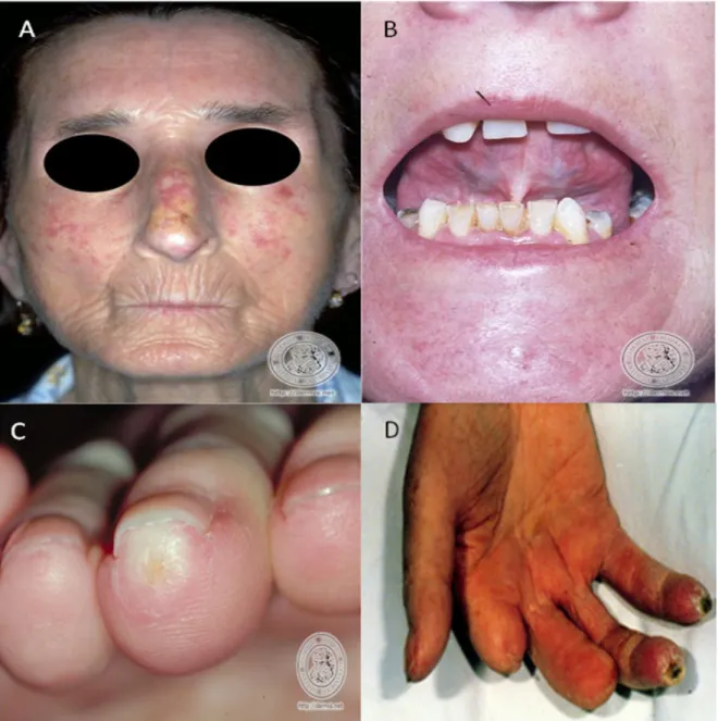 FIGURA 5: Lesões e características da SSc. (A) Face esclerótica . (B) Lesão no tecido bucal  (C) Lesão inicial na ponta dos dedos (D) Necrose na ponta dos dedos