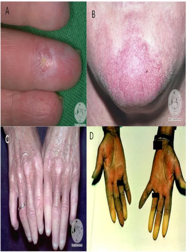 FIGURA  6:  Danos  que  compõem  a  síndrome  CREST  :    (A)  Calcinose  cutânea.  (B)  Telangiectasia