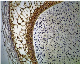 Fig. 4. Immunohistochemical reactivity for E-cadherin in unicystic ameloblastoma, showing membranous and  cyto-plasmic reactivity in neoplastic cells (⫻400).