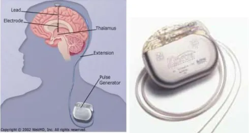 Figure 1.1.2.1 – Deep Brain Stimulation schematic figure and Implantable Pulse Generator