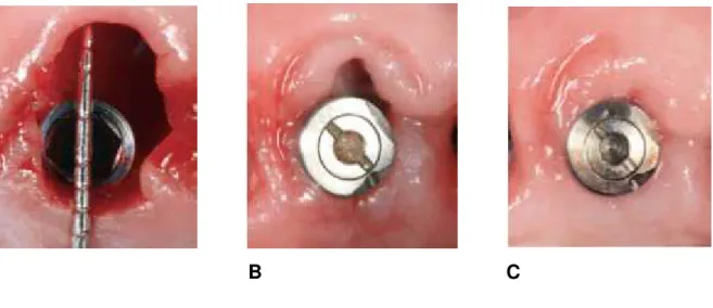 Figura 5: Um  implante  com  conexão  interna  rosqueada  (NanoTite  NT)  foi  inserido mais palatinizado um alvéolo fresco