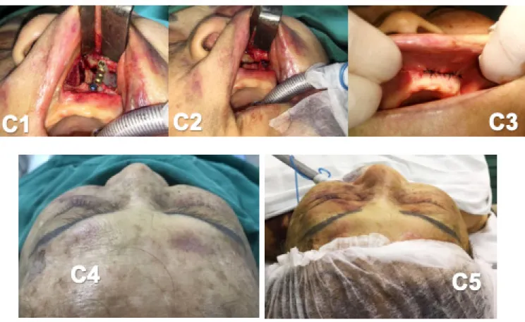 Figura C: Antes do procedimento cirúrgico                          Depois do procedimento cirúrgico, volume de zigoma devolvido