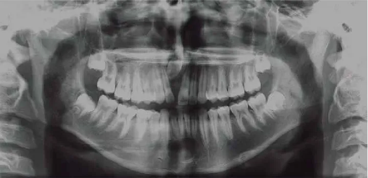 Figura 1. Radiografia panorâmica, demonstrando a imagem radiopaca do dente 11 retido.   