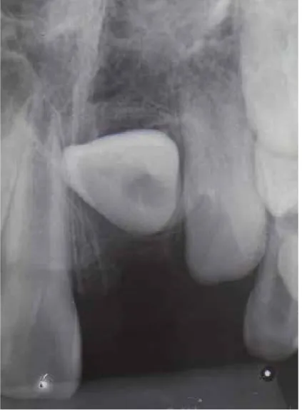 Figura 7. Dente 11 em radiografia periapical.