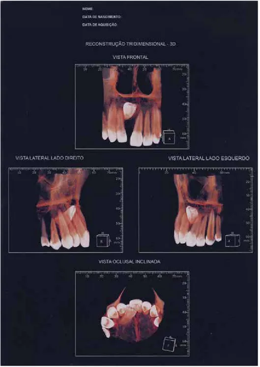 Figura 8. Reconstrução tridimensional em 3D, demonstrando dente 11, com ápice voltado para distopalatino, bem como  coroa apontada para a fossa nasal