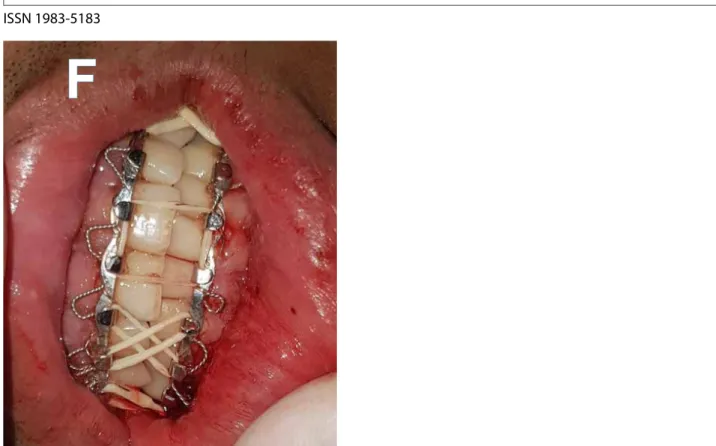 Figura F: Ao que se observa na imagem, devido à memória muscular e posição mandibular, foi realizado o bloqueio  maxilomandibular semirrígido.