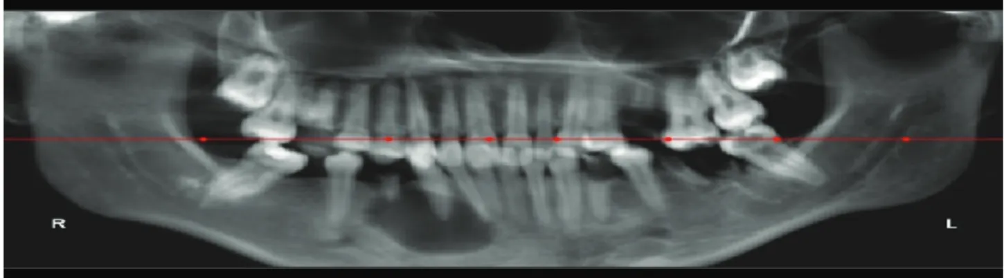 Figura 2: Radiografia panorâmica com uma extensa área radiolúcida relacionada à raiz residual 44