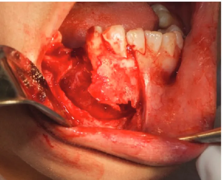 Figura 3: Transcirúrgico com exposição do processo patológico.