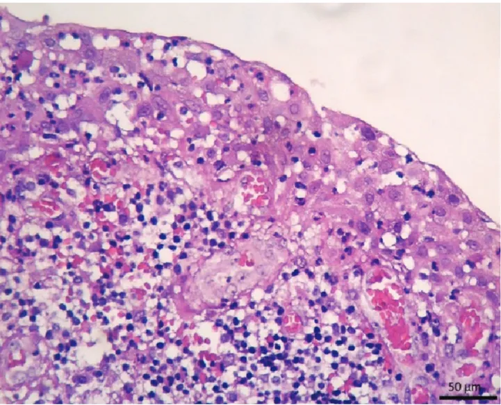 Figura 4: Cisto revestido por epitélio escamoso estratificado, o qual contém um infiltrado inflamatório crônico