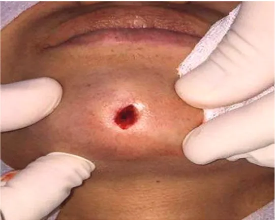 Figura 5: Plastia da fístula. Momento após a exérese da lesão.   