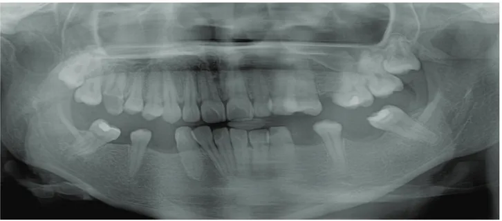 Figura 7: Tomada radiográfica panorâmica de acompanhamento após um ano e meio da cirurgia