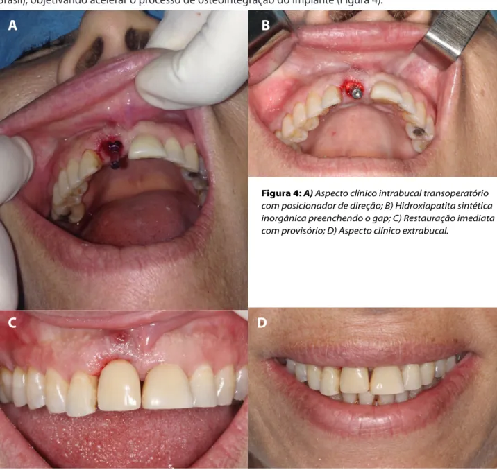 Figura 4: A) Aspecto clínico intrabucal transoperatório  com posicionador de direção; B) Hidroxiapatita sintética  inorgânica preenchendo o gap; C) Restauração imediata  com provisório; D) Aspecto clínico extrabucal.