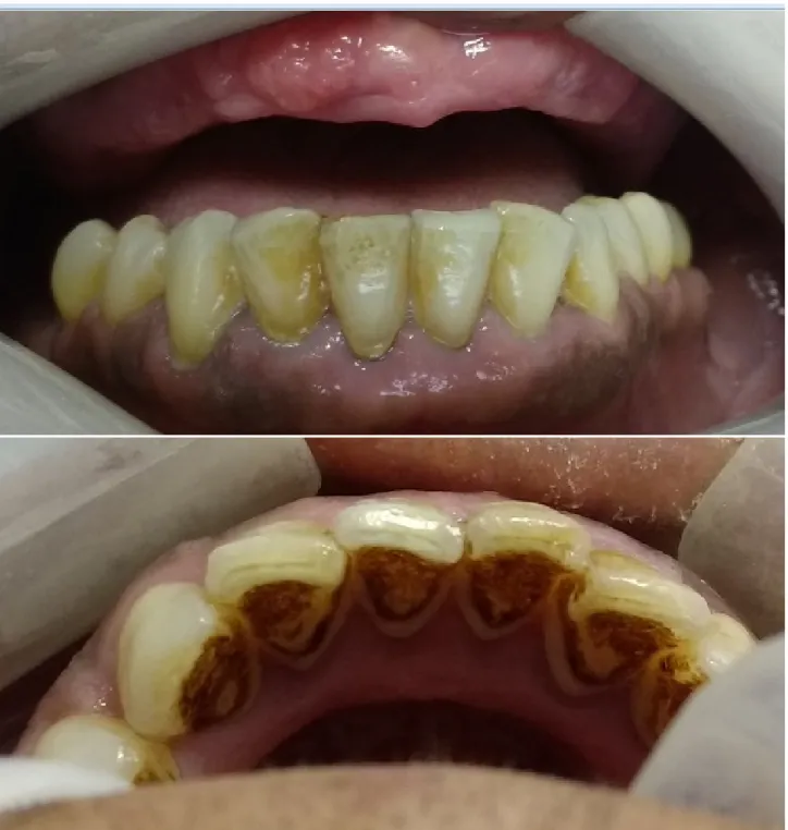 Figura 1 – Condição bucal prévia ao tratamento radioterápico: edentulismo superior, em uso de prótese total, e doença  periodontal crônica nos dentes inferiores.