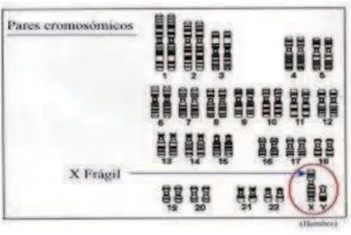 Figura 1: Representação da mutação do cromossoma do X Frágil 