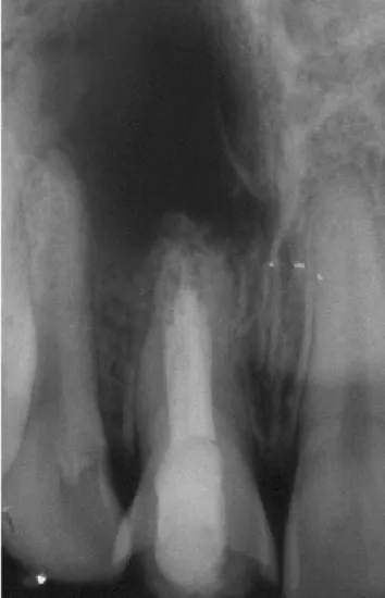 Figura 1:   Radiografia inicial exibindo lesão periapical  extensa do dente 11.