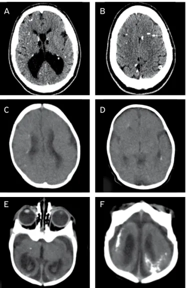 Figura 2.  Tomografia computadorizada de crânio de pacientes com  infecções congênitas.