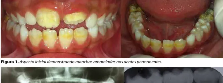 Figura 1. Aspecto inicial demonstrando manchas amareladas nos dentes permanentes.