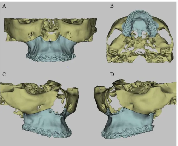 Figura 01: Reconstrução tomográfica ilustrando a Osteotomia do tipo Le Fort I. Em amarelo parte do crânio que  fica fixa e em azul parte maxilar que sofrerá movimentação