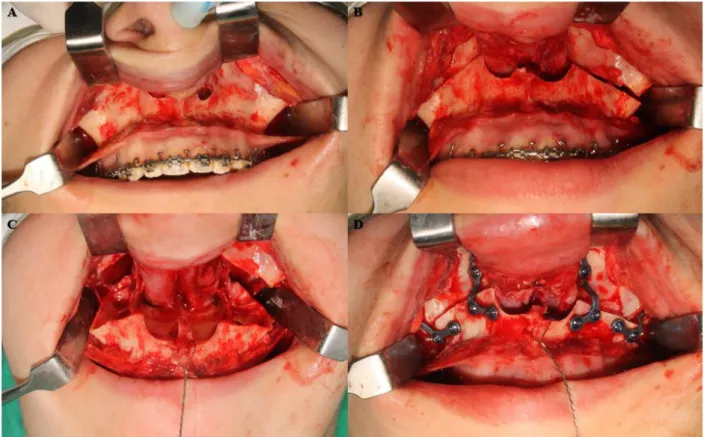 Figura 02: Osteotomia Le Fort I em paciente submetido a cirurgia ortognática. (A): Exposição da maxila após a  realização da incisão e descolamento mucoperiosteal  podendo visualizar da abertura piriforme até a região dos  pilares zigomáticos bilateralment
