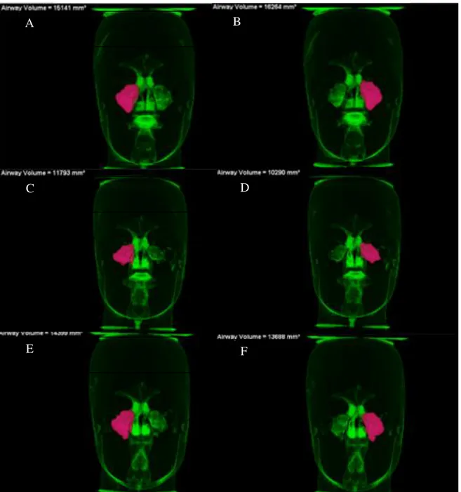 Figura 01: Avaliação do volume do espaço aéreo dos seios maxilares 