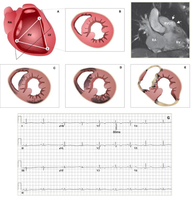 Figure  2.  Schematic  disease  progression,  electrocardiographic  and  imaging  features  in  ARVC