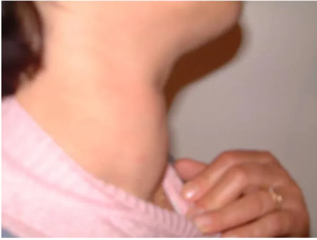 Figure 1 – Diffuse goiter