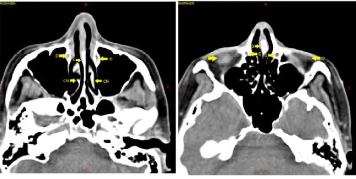 Figura 1:   Tomografia computadorizada de face, corte  axial, altura da concha nasal inferior