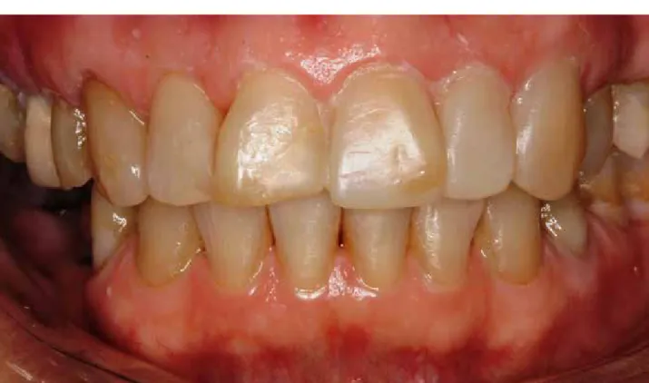 Figura 1.   Paciente com “mock-up” do lado esquerdo, até canino, e com dentes manchados, quebrados e escurecidos do  lado direito