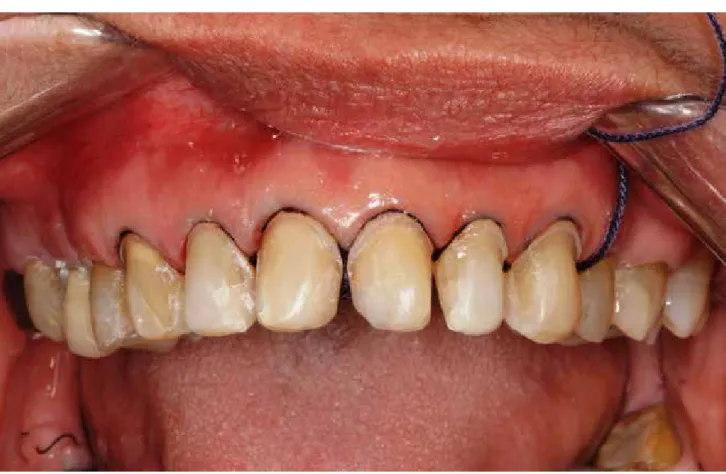 Figura 3. Inserção de fio zero-zero no interior dos sulcos gengivais dos dentes preparados.