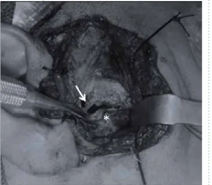 FIGURA 2.  Imagen de  cirugía abierta  de la  articula-ción  tempo-romandibular  donde se  evidencia la  presencia de  brida (flecha)  y perforación  del disco (*)