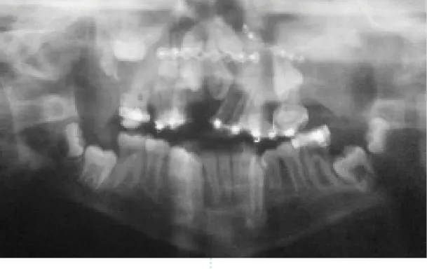 Figura 6:  Observa-se em radiografia panorâmica a presença de placa cirúrgica para  osteossíntese na região nasal e na região de assoalho de órbita esquerda