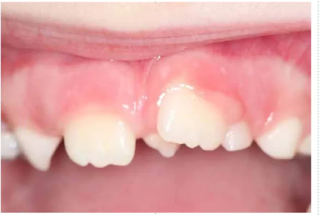 Figura 1. dente supranumerário entre os incisivos centrais/ “mesiodens”