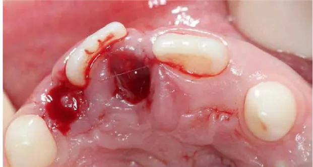 Figura 4.   aspecto clínico após o procedimento cirúrgico de remoção do dente supranumerá- supranumerá-rio.