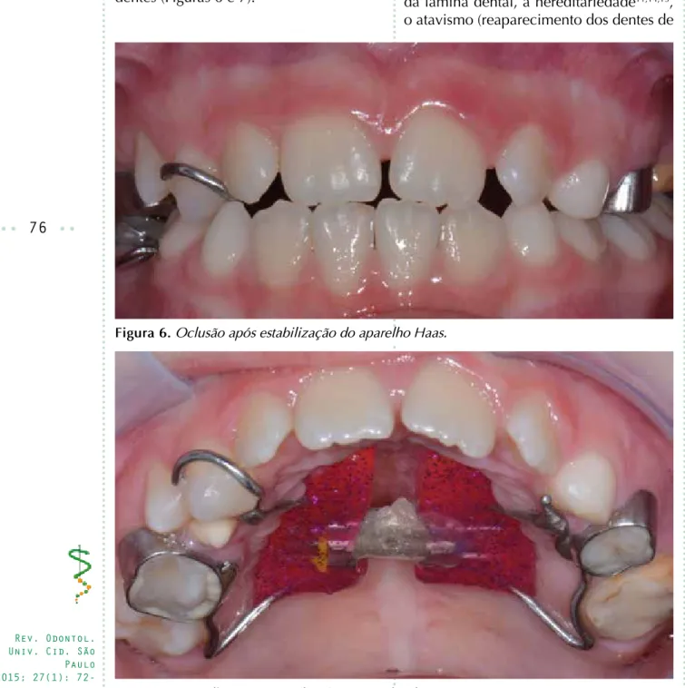 Figura 6. oclusão após estabilização do aparelho haas.