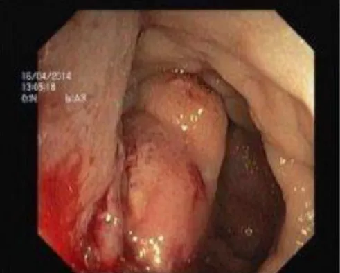 Fig. 1 Lesão do recto observada por  colonoscopia. 