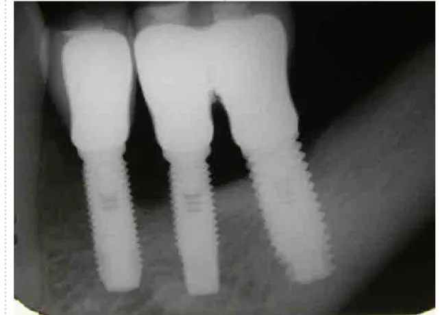 Figura 8: aspecto radiográfico dos implantes após instalação das próteses.