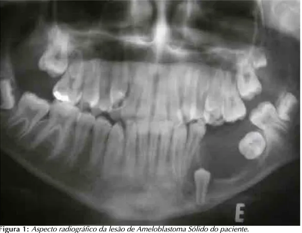 Figura 2:  fragmento ósseo de crista ilía- ilía-ca fixado no corpo mandibular  esquerdo.