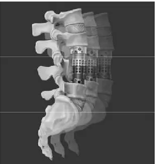 Figura 2-12 - Implantes metálicos dos segmentos metálicos da coluna vertebral [Enderle et al., 2005] 