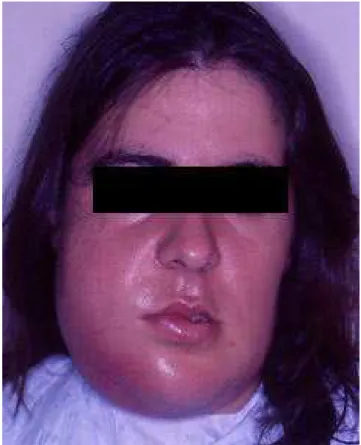 Figura 4 – Doente com infeção do espaço bucal (imagem cedida pelo Prof. Doutor Francisco Salvado) 