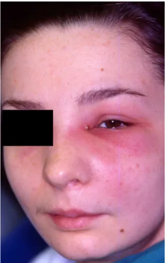 Figura 5 – Doente com infeção do espaço infraorbitário com drenagem lacrimal (imagem cedida pelo  Prof