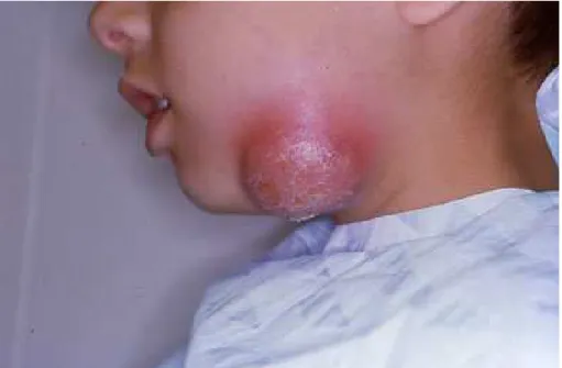 Figura 10 – Doente com infeção do espaço submandibular (imagem cedida pelo Prof. Doutor Francisco  Salvado) 