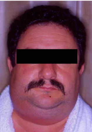 Figura 16 – Doente com angina de Ludwig com significativo aumento do volume da face (imagem cedida  pelo Prof